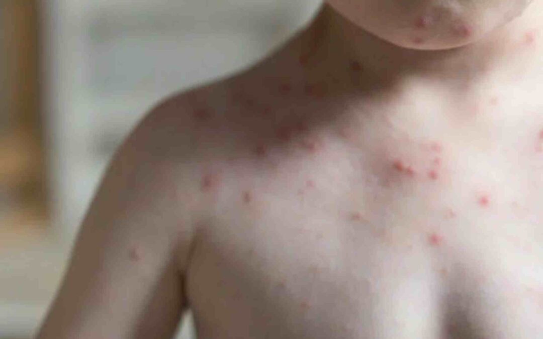 Confirma SSM primeros casos de sarampión en Michoacán